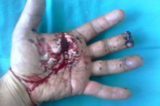 Injured child's hand